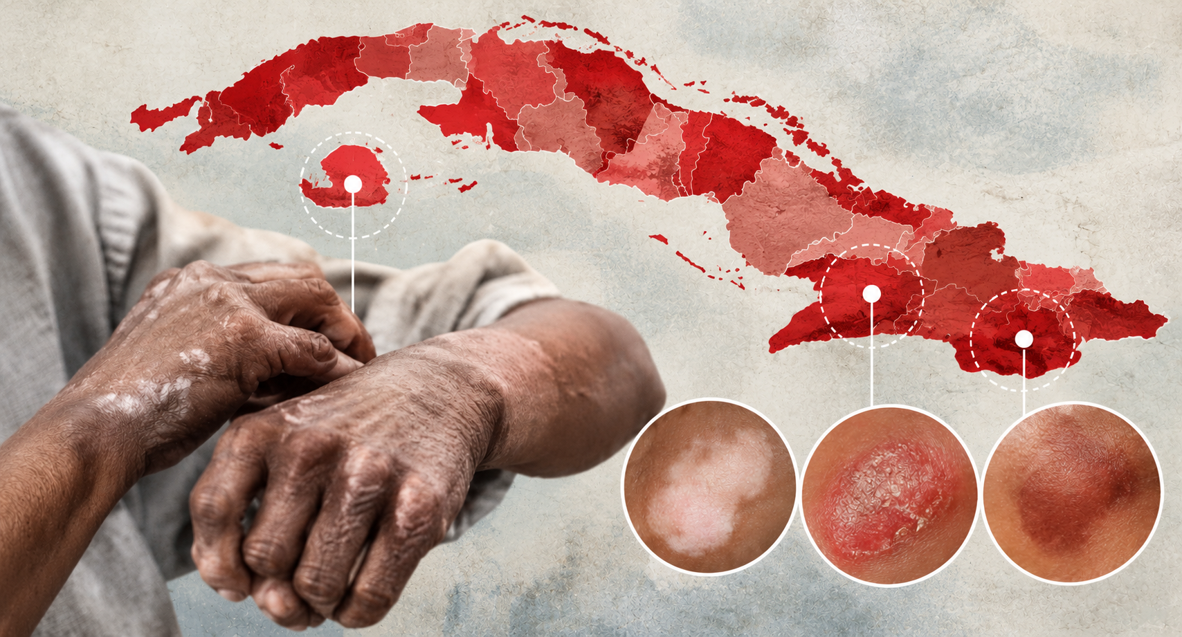 La cifra confirma la persistencia de esta enfermedad infecciosa en la isla, donde los servicios sanitarios reportan nuevos diagnósticos cada año.