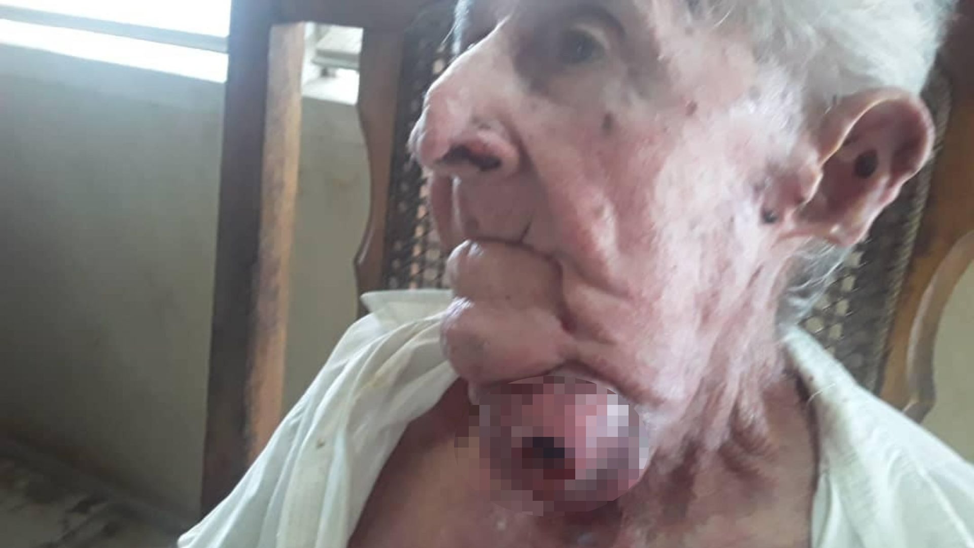 Anciano cubano sin poder operarse ante la ausencia de cirujanos maxilofaciales