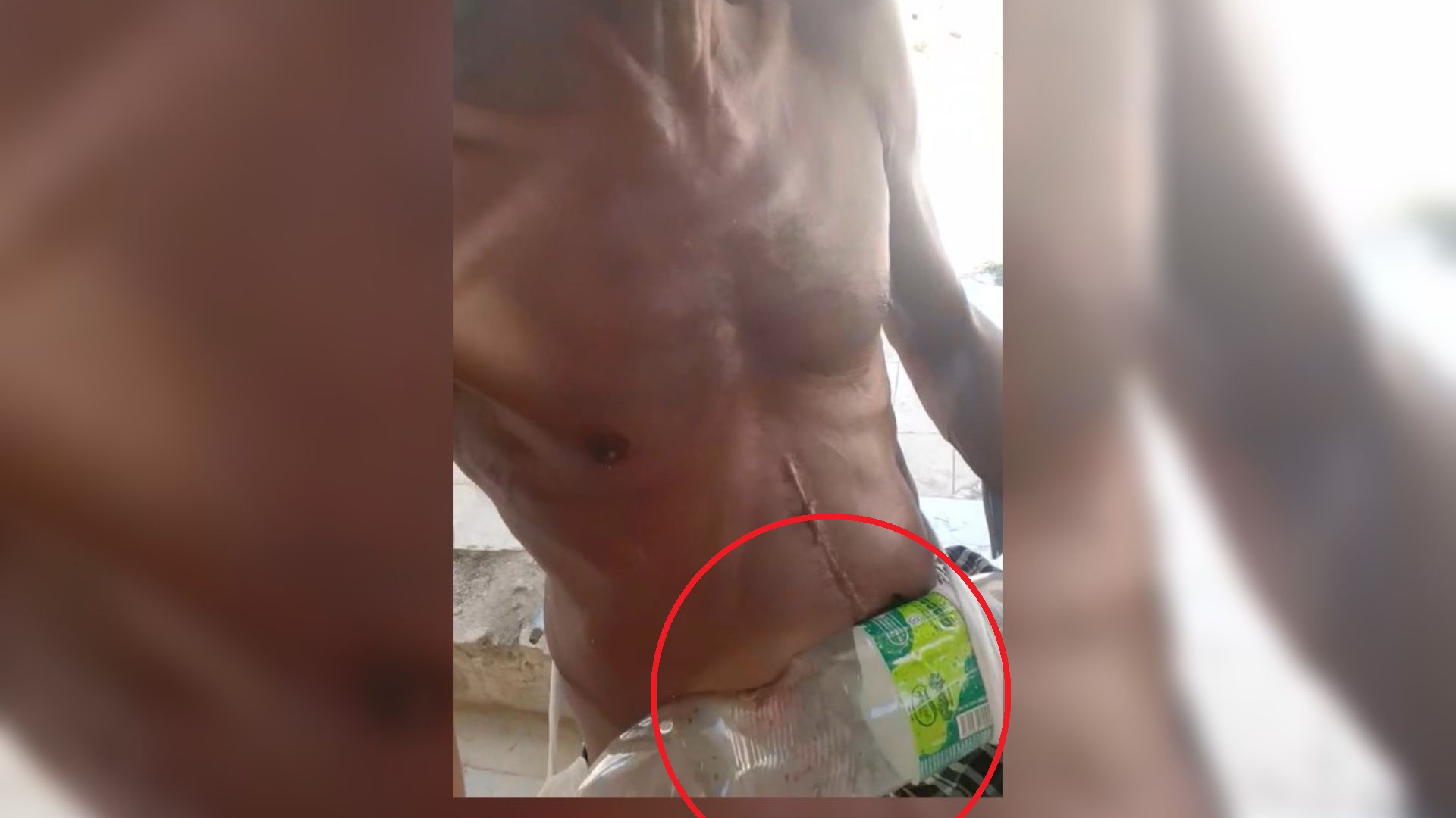 Anciano cubano usa pomo plástico para colostomía: "Hagan algo por este señor"