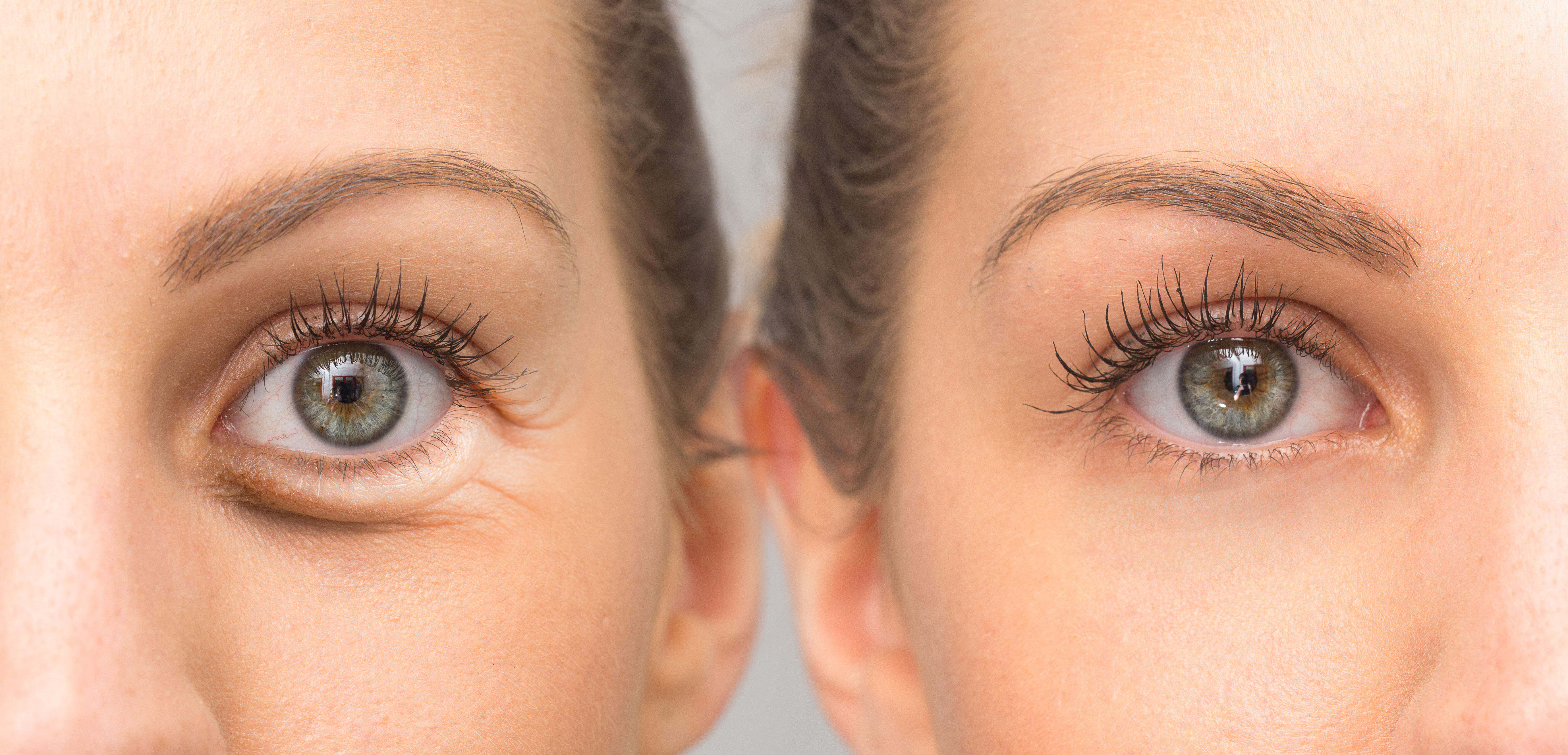 ¿Cómo reducir las bolsas debajo de los ojos de forma natural?