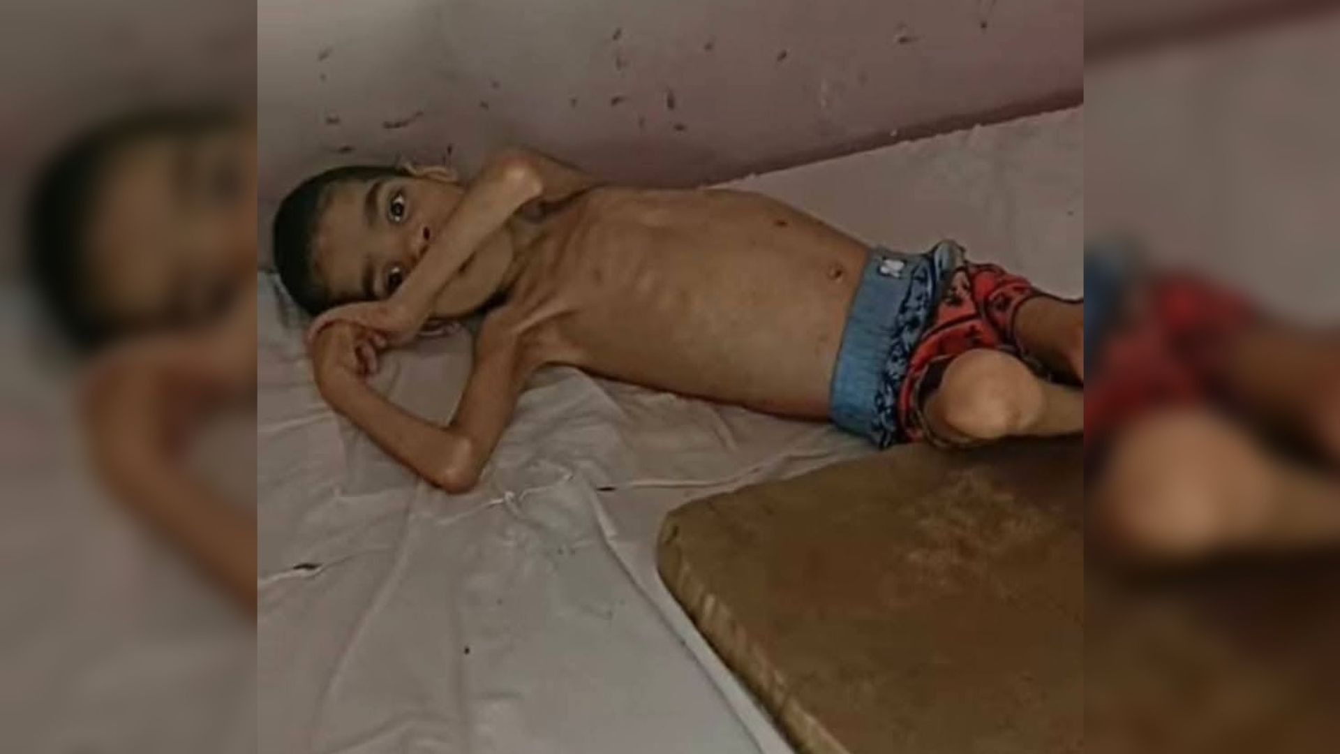 Denuncian caso de niño desnutrido en El Guayabo, Camagüey