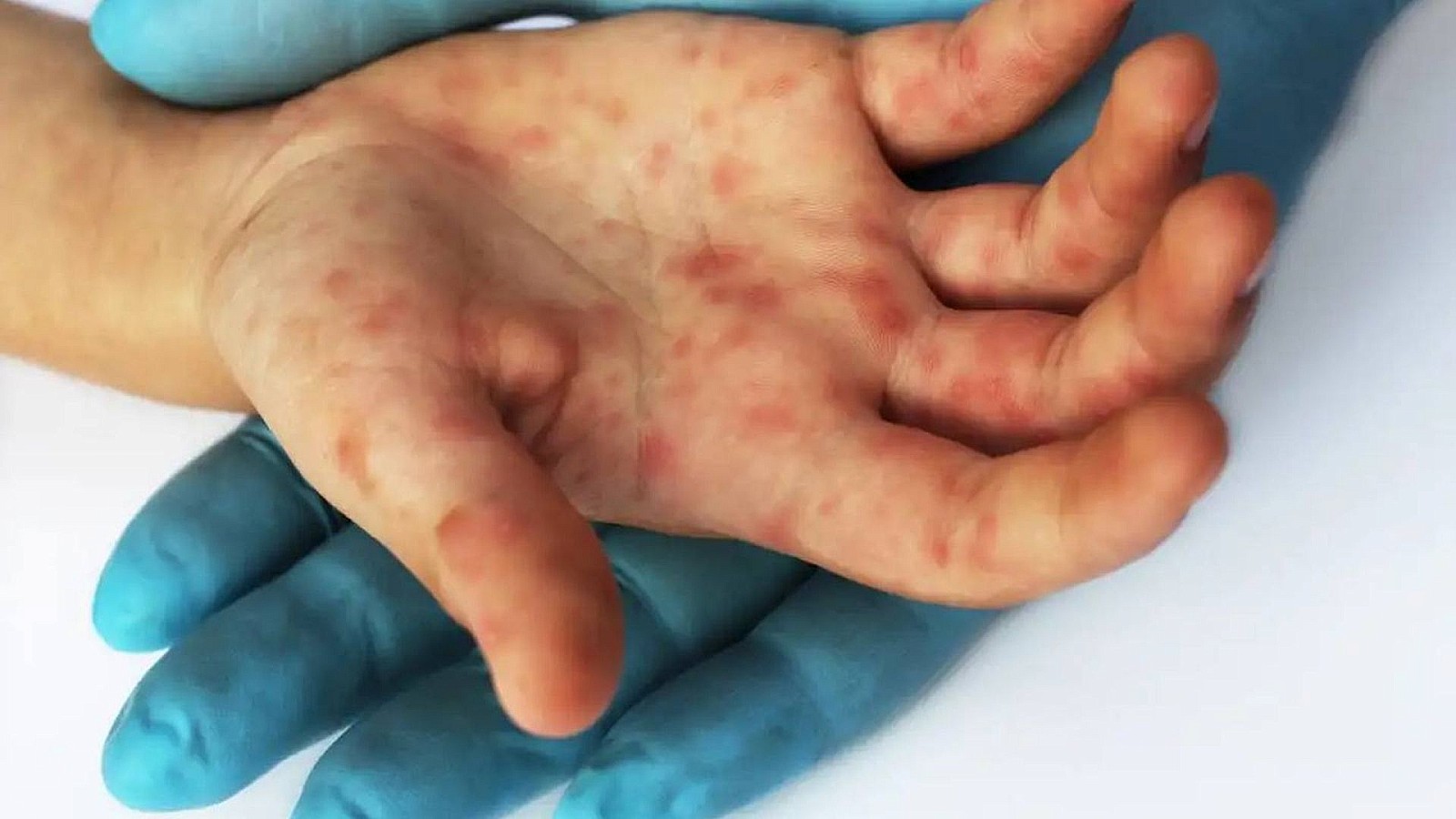 Diagnostican a cuarto paciente con viruela del mono