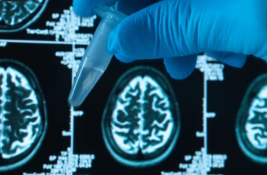 La Inteligencia Artificial ya puede predecir si padecerás Alzheimer
