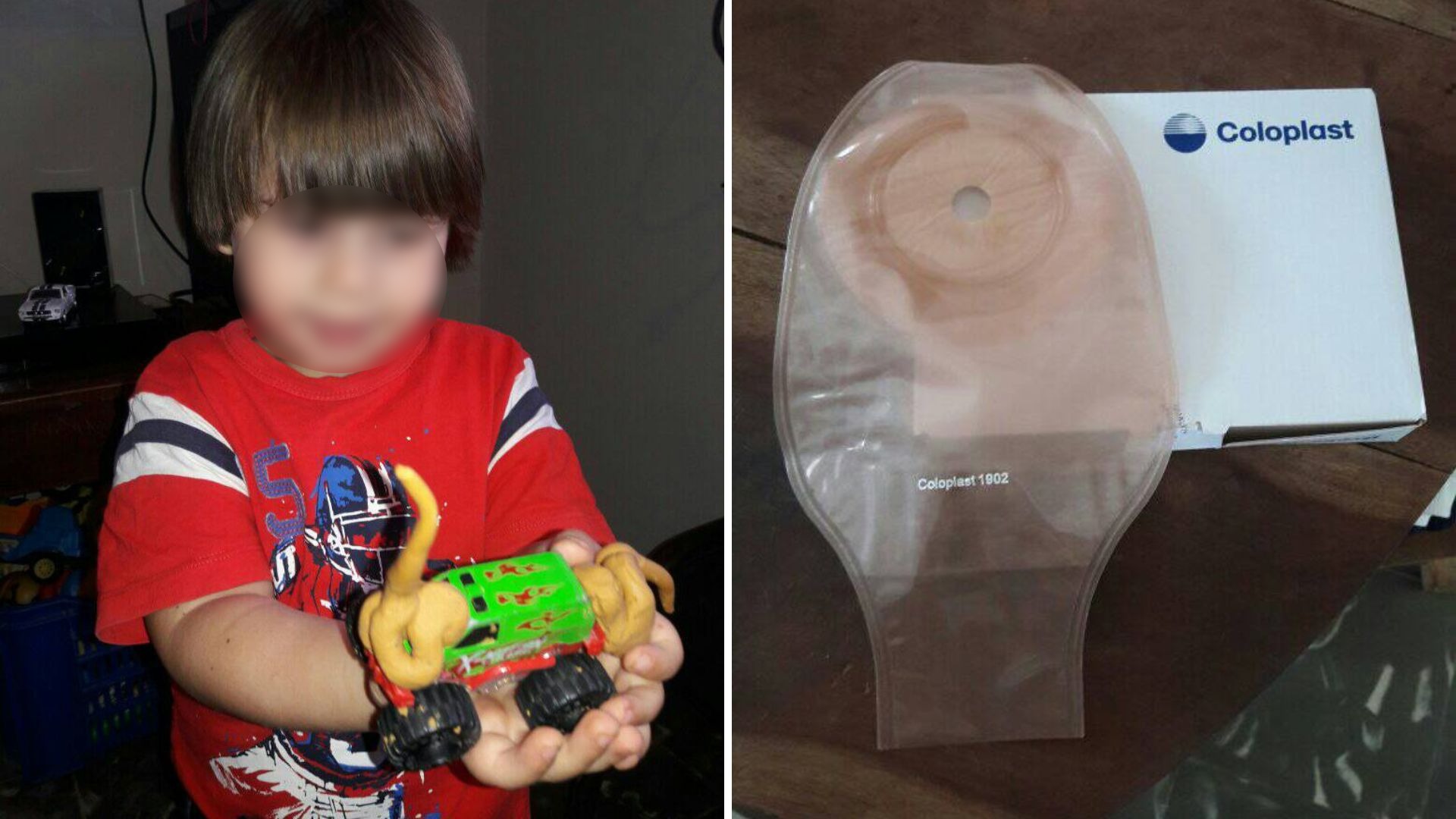 Niño de 4 años necesita bolsas de colostomía en Cuba