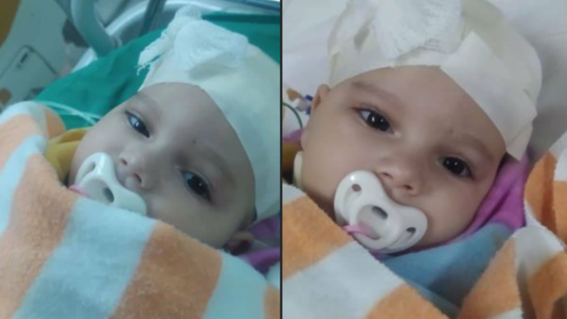 Operan a bebé cubana con tumor en la cabeza tras más de un mes de espera