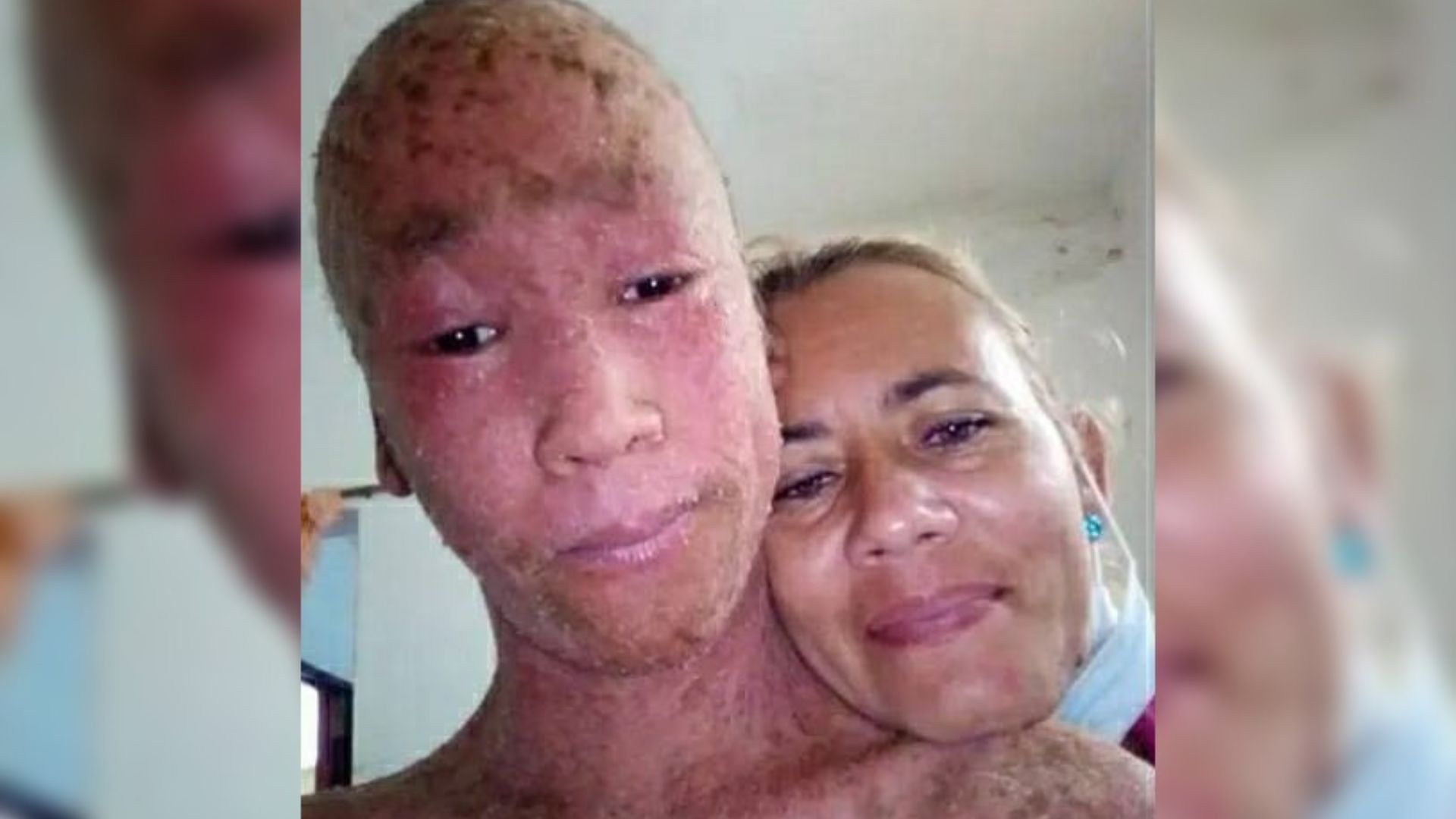 Piden ayuda para adolescente cubano con rara enfermedad