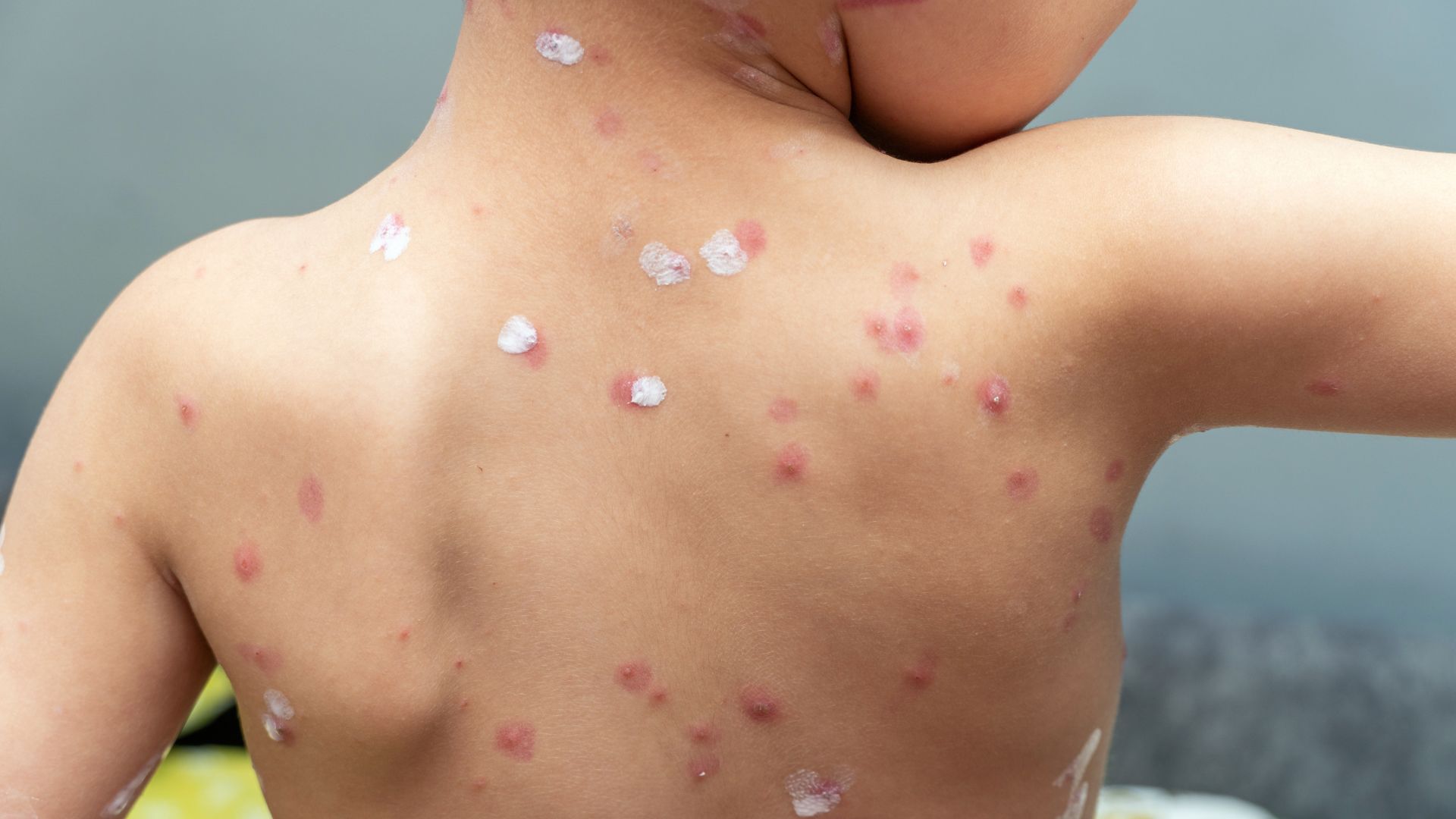 Reportan epidemia de varicela en Sancti Spíritus: más de 120 enfermos
