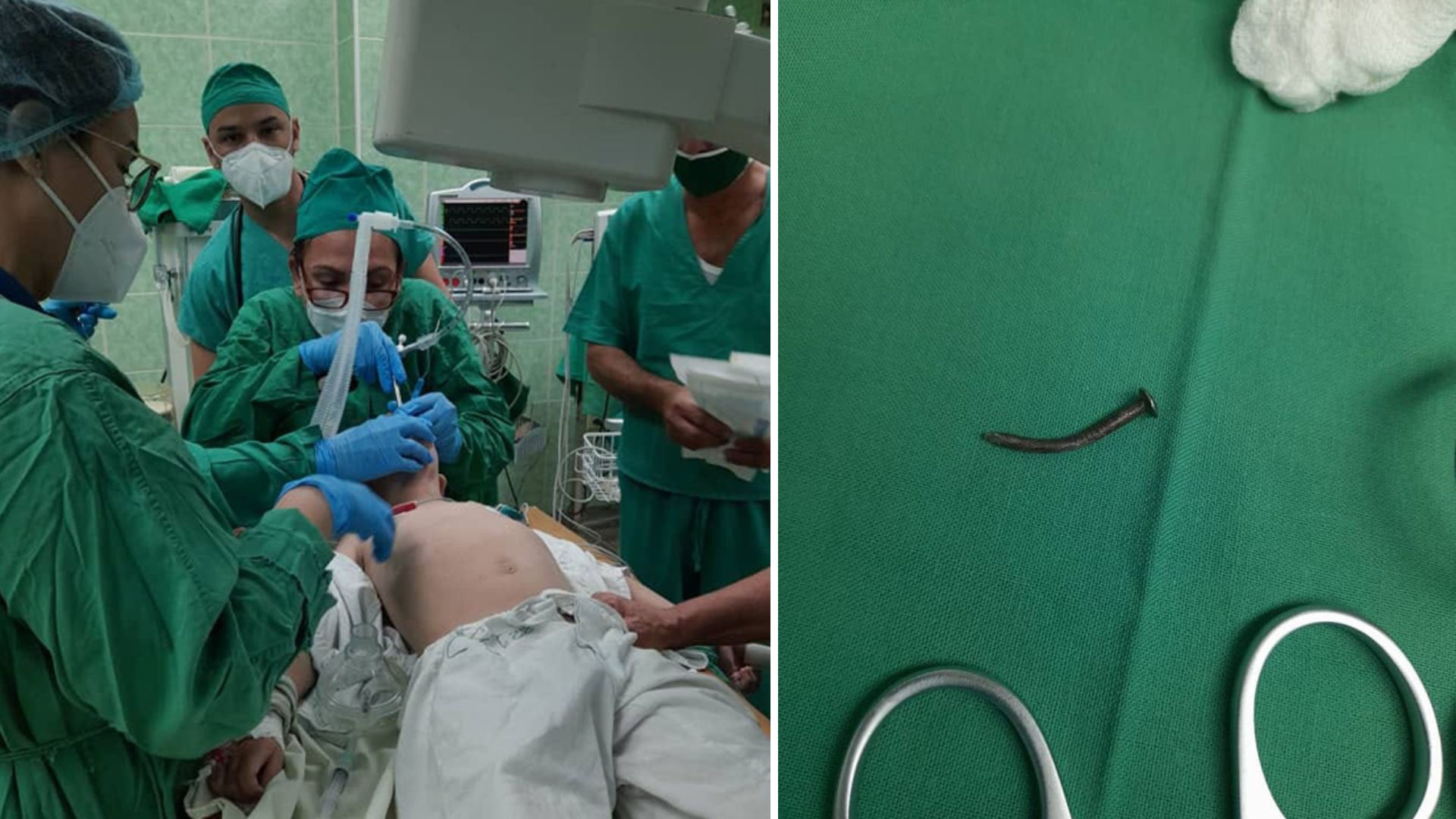 Sobrevive niño cubano de 3 años que se tragó un clavo