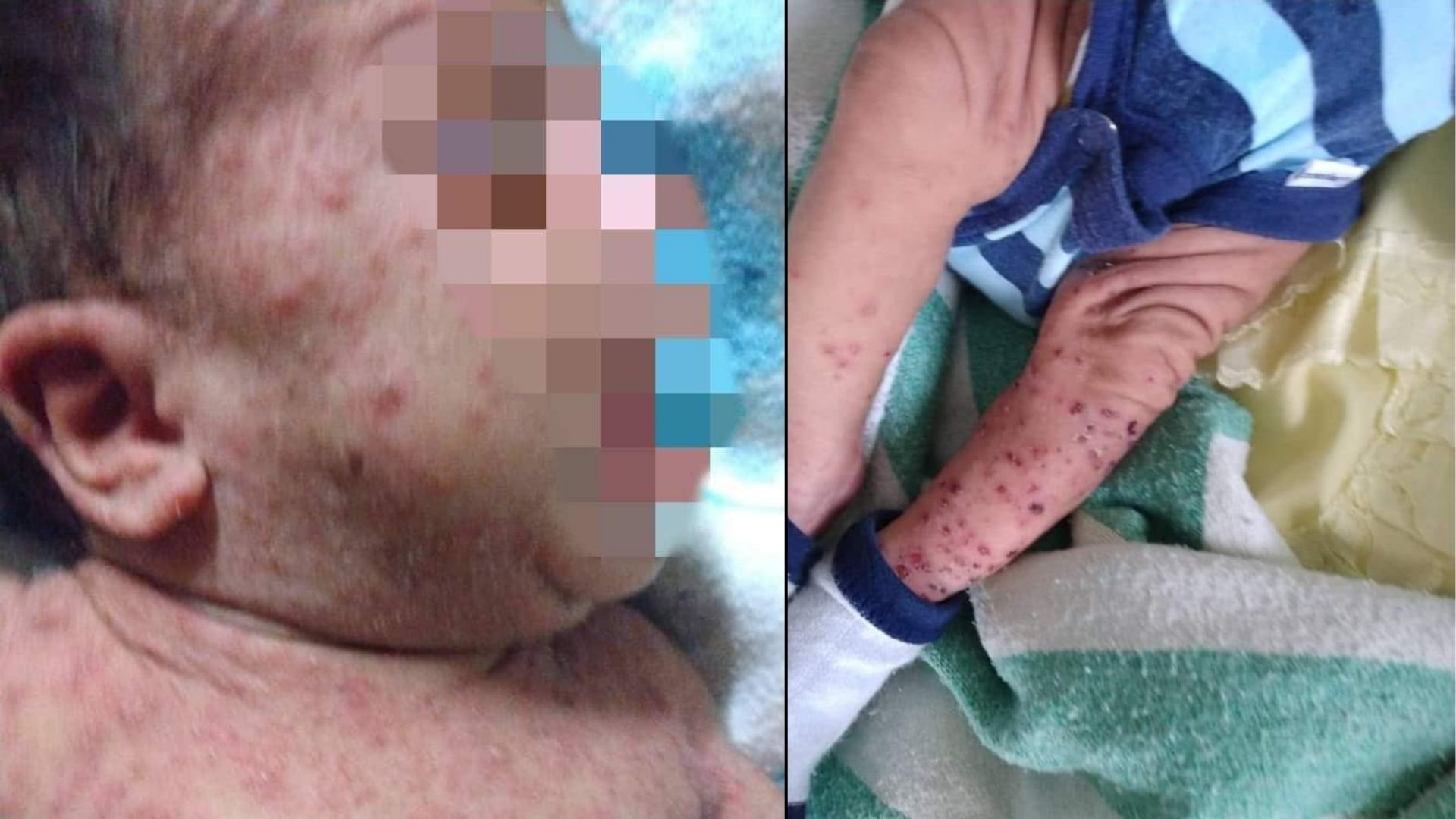 Solicitan ayuda para bebé con escabiosis aguda en La Habana