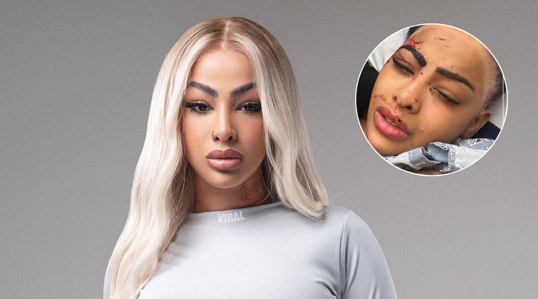 Yailin La Más Viral aparece golpeada: una foto se hace viral y ella explica todo